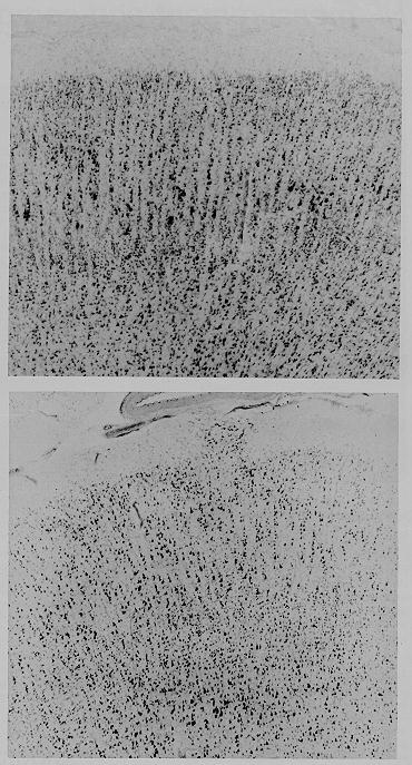Comparison pictures of normal and Learning Disability brain